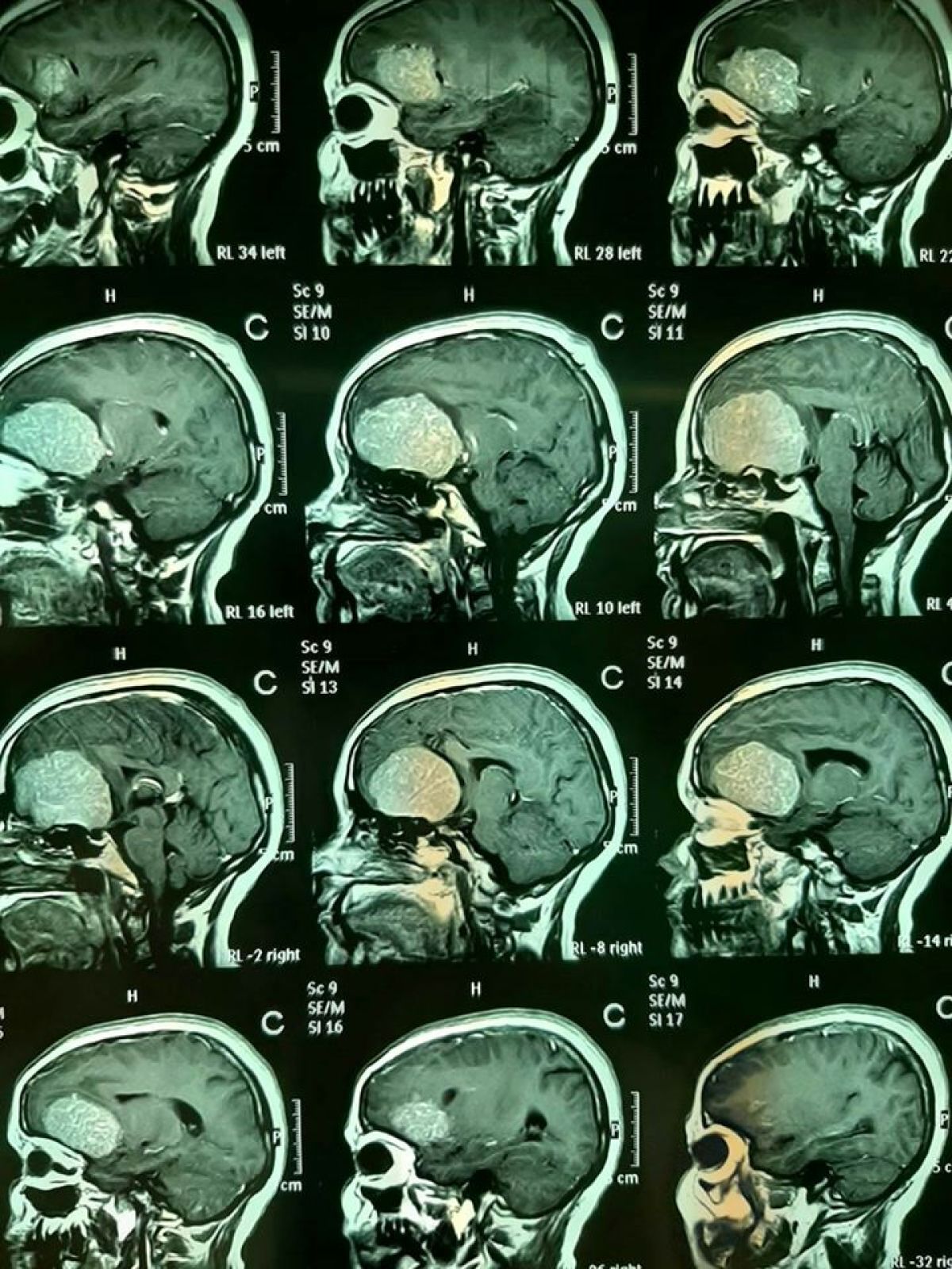 عملية تستغرق (9) ساعات لإزالة ورم من رأس مريضة